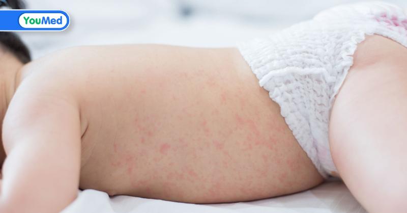 Bảng so sánh các loại kem và sản phẩm bôi trị rôm sảy phổ biến cho bé